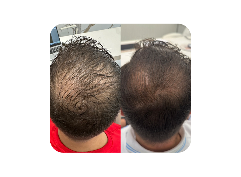 Antes e depois 4